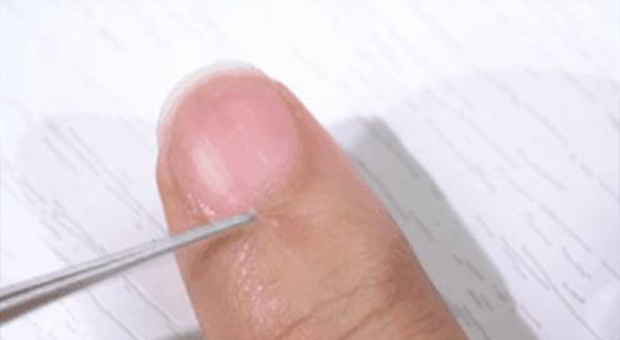 手上長倒刺是缺維生素？兩碼事兒！