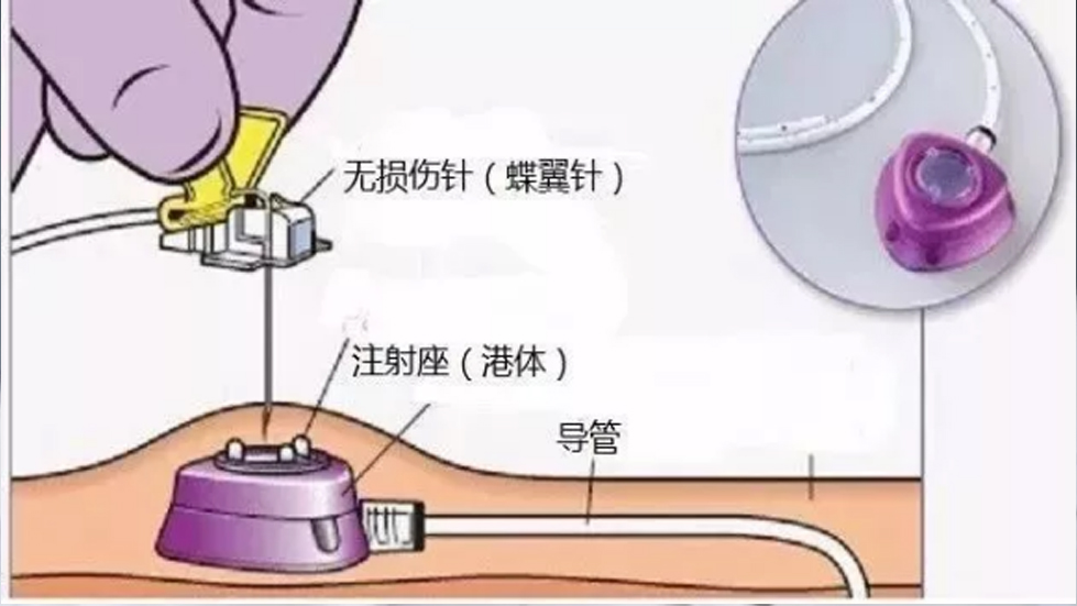 多學(xué)科協(xié)作破高齡治療難題，輸液港技術(shù)啟精準(zhǔn)醫(yī)療新篇--太原市第七人民醫(yī)院